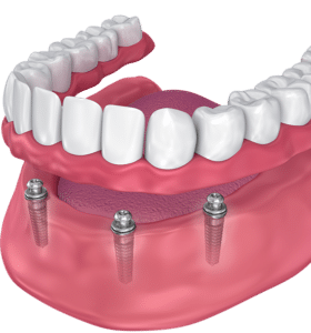 mexico dental implants